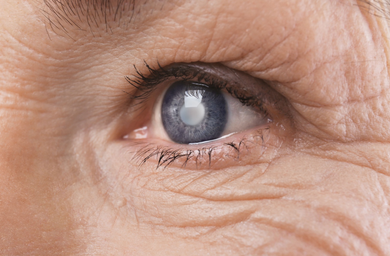 A close up of an eye with a cataract.